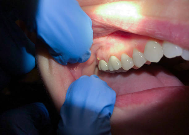 Best Emergency Wisdom Teeth Removal in Lan, MI